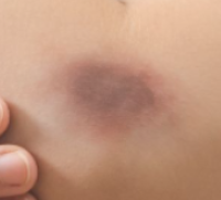 あざのような暗い紫色のシミの写真