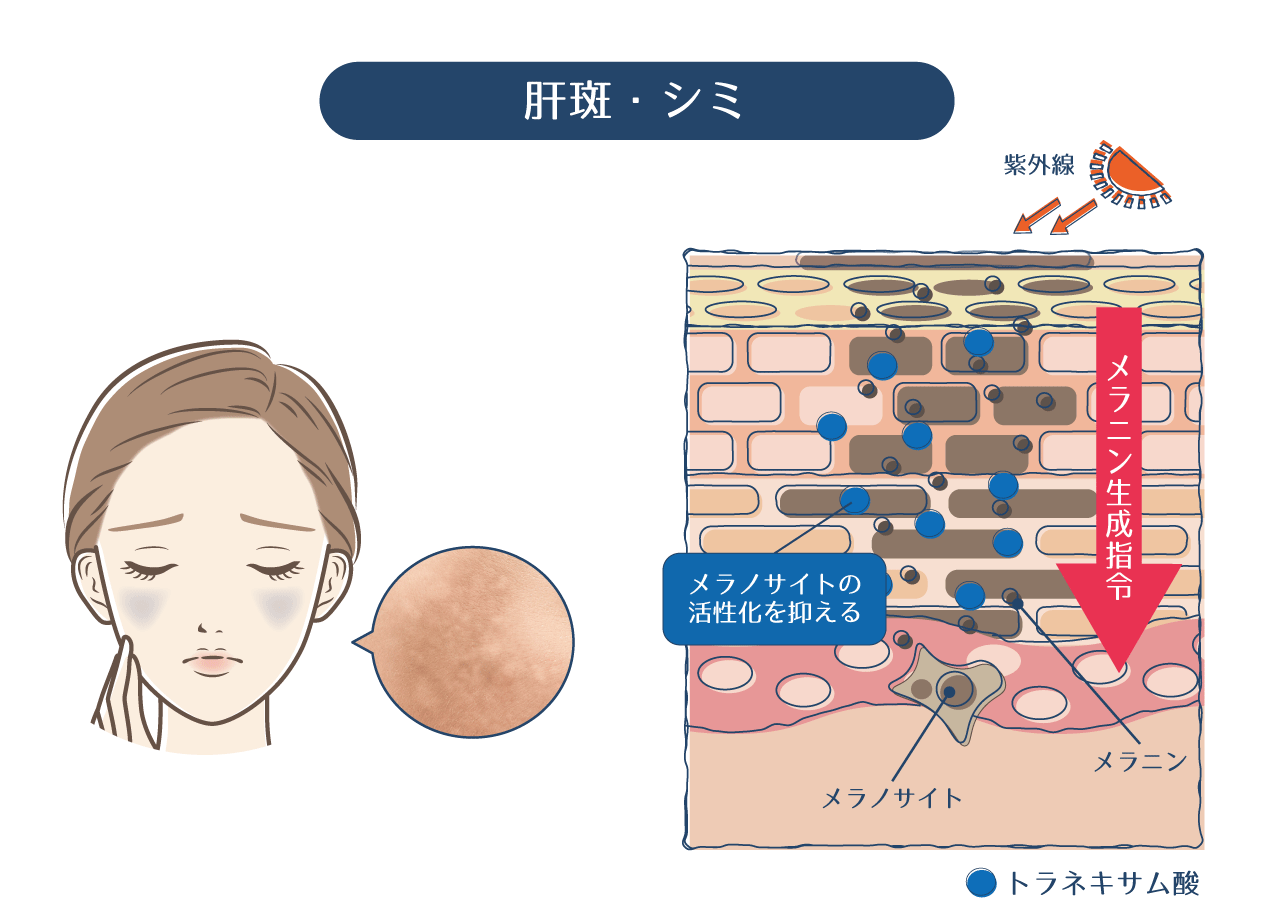 トラネキサム酸が作用してメラノサイトの活性化を抑えて肝斑・シミを改善することを表している画像