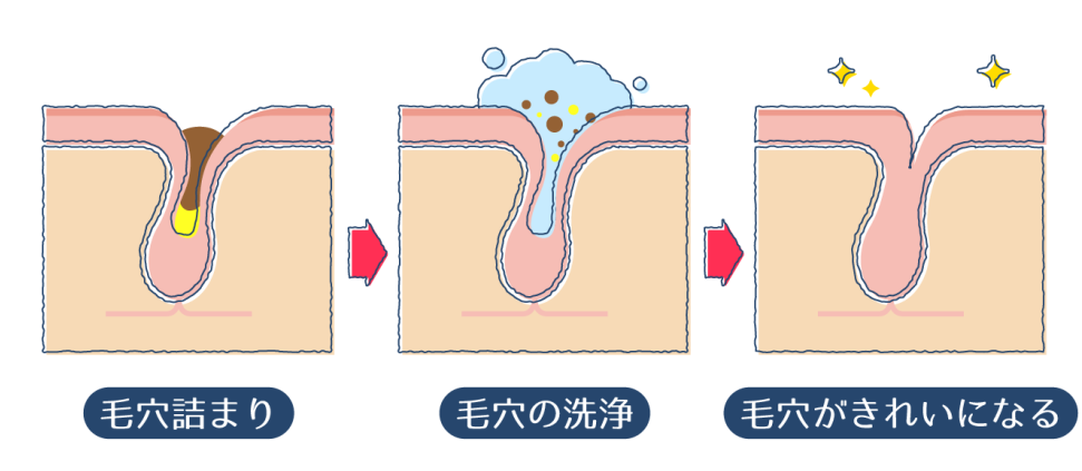 洗顔で、毛穴に溜まった汗や皮脂汚れを除去する画