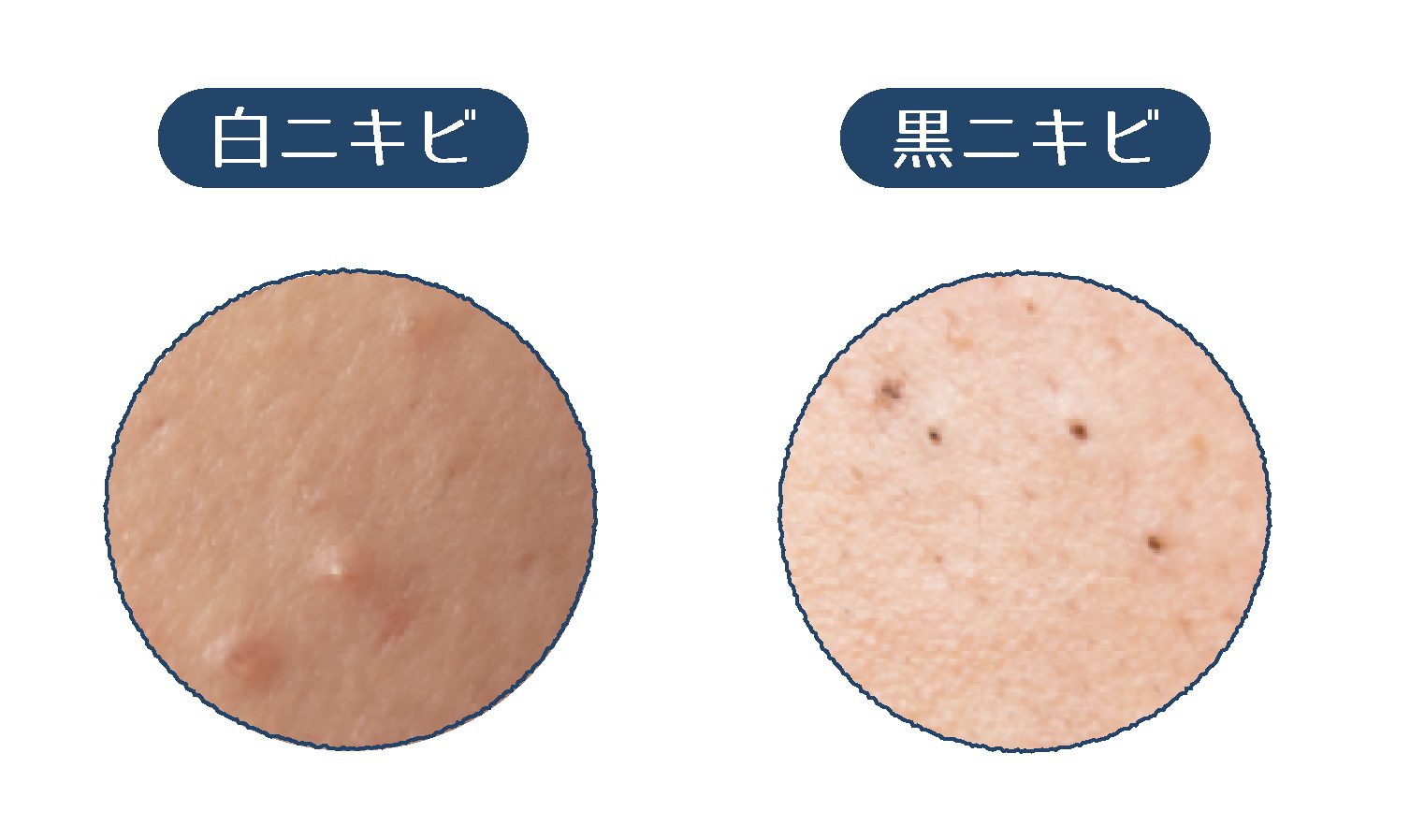 白ニキビと黒ニキビの画像
