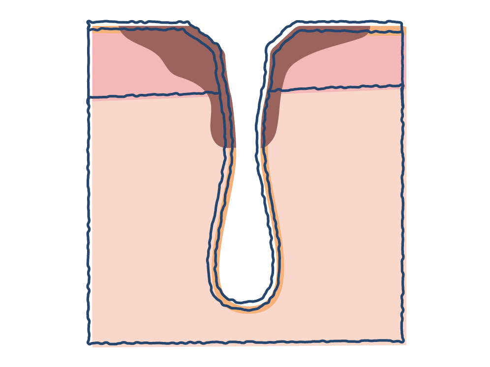 黒ずみ毛穴のメカニズム